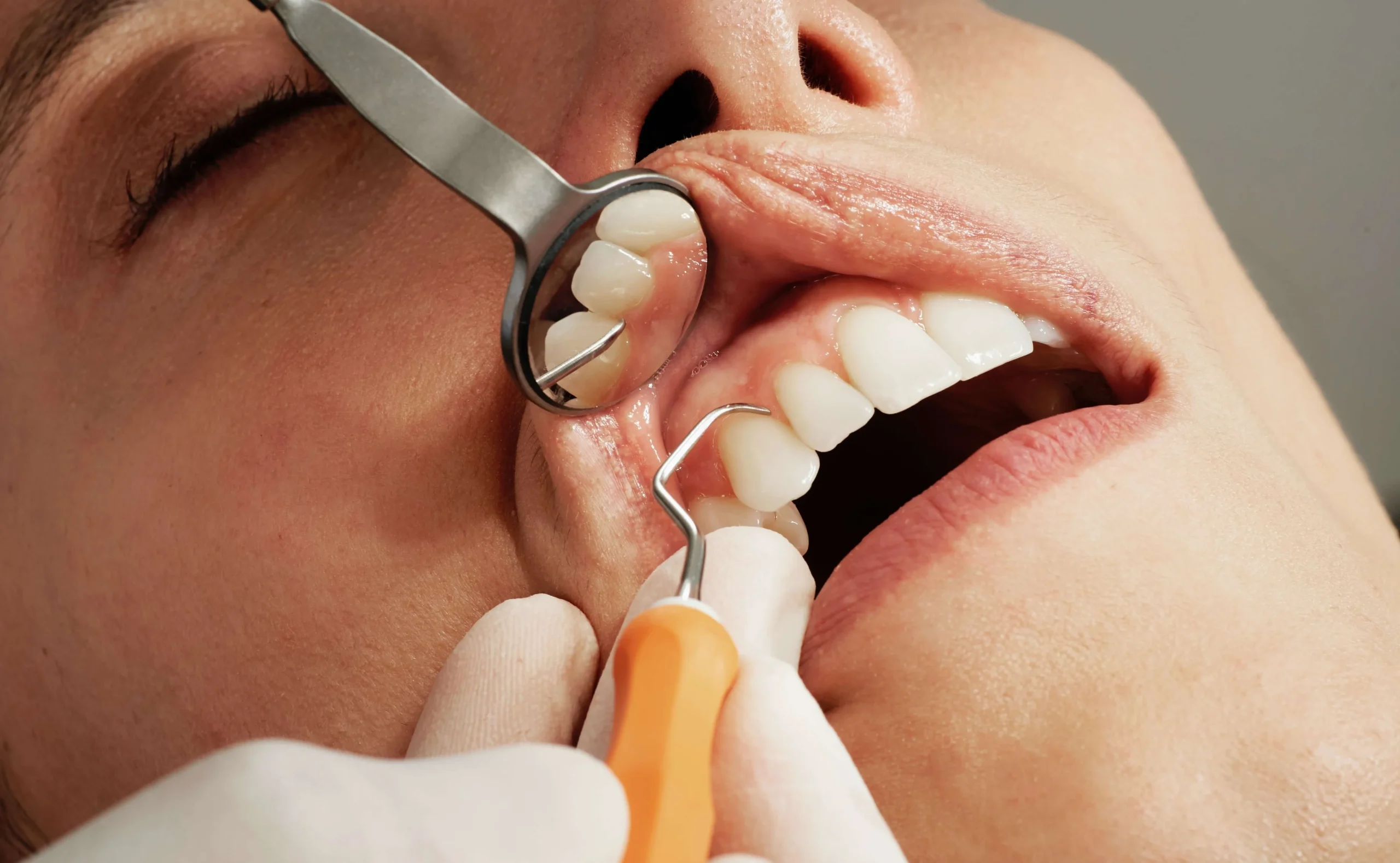 Dental Implants